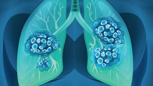 Բրիտանացի գիտնականները հայտնել են թոքերի քաղցկեղի դեմ քիմիաթերապիայից ավելի արդյունավետ միջոց գտնելու մասին