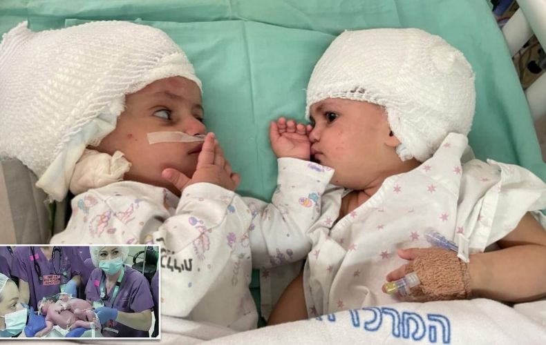 Իսրայելում առաջին անգամ սիամական երկվորյակների հաջող վիրահատություն է իրականացվել (տեսանյութ)