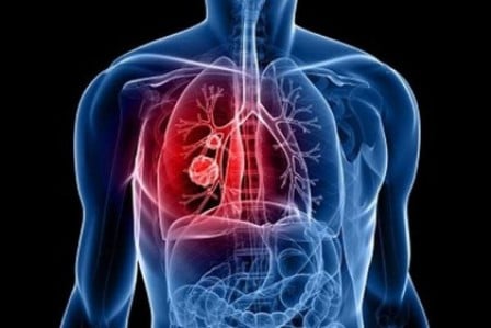 Հայաստանում թոքի քաղցկեղ ունեցող 10 անձից 8-9-ի դեպքում պատճառը ծխելն է․ Ուռուցքաբանության կենտրոնի տնօրեն