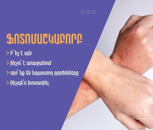 Ինչպե՞ս խուսափել ֆոտոմաշկաբորբից. ԱՆ